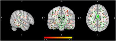 Multimodal neuroimaging in Long-COVID and its correlates with cognition 1.8 years after SARS-CoV-2 infection: a cross-sectional study of the Aliança ProHEpiC-19 Cognitiu